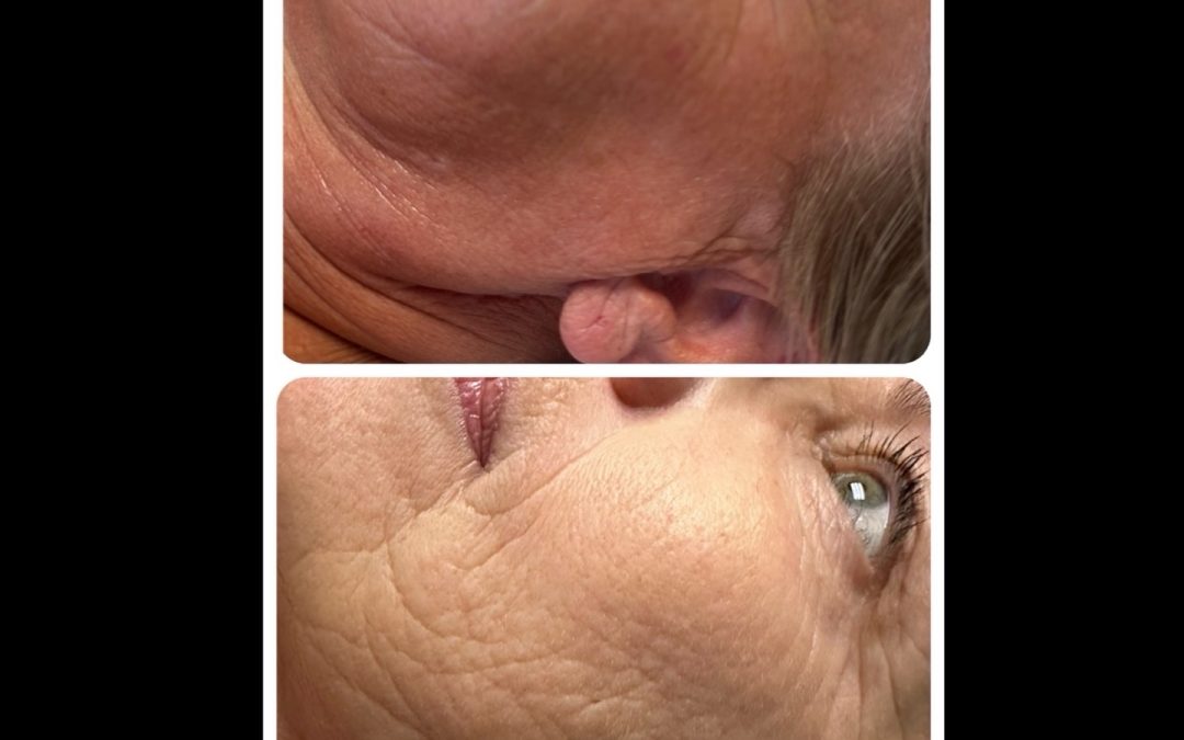 SkinPen Microneedling – Fördelarna med en Säker och Effektiv Behandling